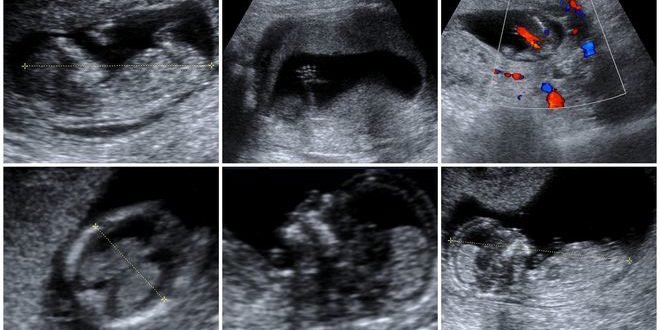Doppler fetal exámenes prenatales